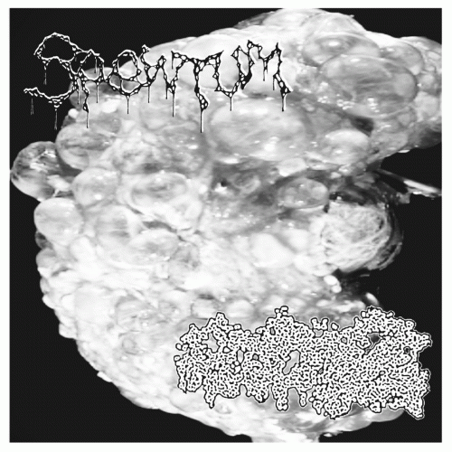 Spewtum : Seborrheic Keratosis - Spewtum